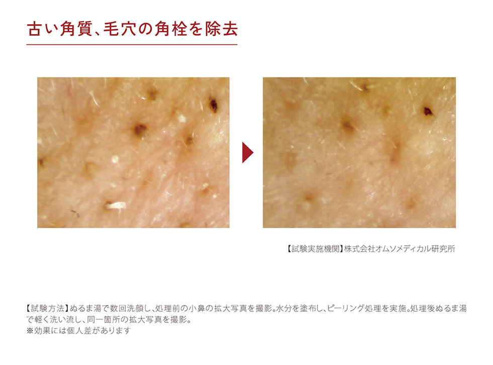 エナージュ ENAGE エステ 超音波ピーリング 使用前後